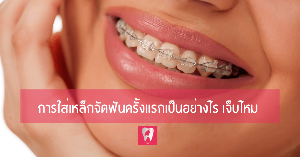 ภาพหัวข้อบทความ การใส่เหล็กจัดฟันครั้งแรกเป็นอย่างไร เจ็บไหม บนภาพรอยยิ้มของคนไข้ที่จัดฟัน