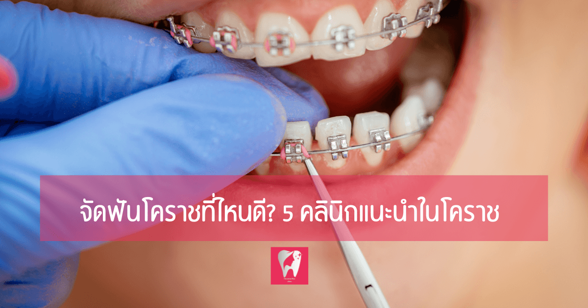 ภาพหัวข้อบทความ จัดฟันโคราชที่ไหนดี 5 คลินิกแนะนำในโคราช บนภาพทันตแพทย์กำลังปรับเหล็กจัดฟัน