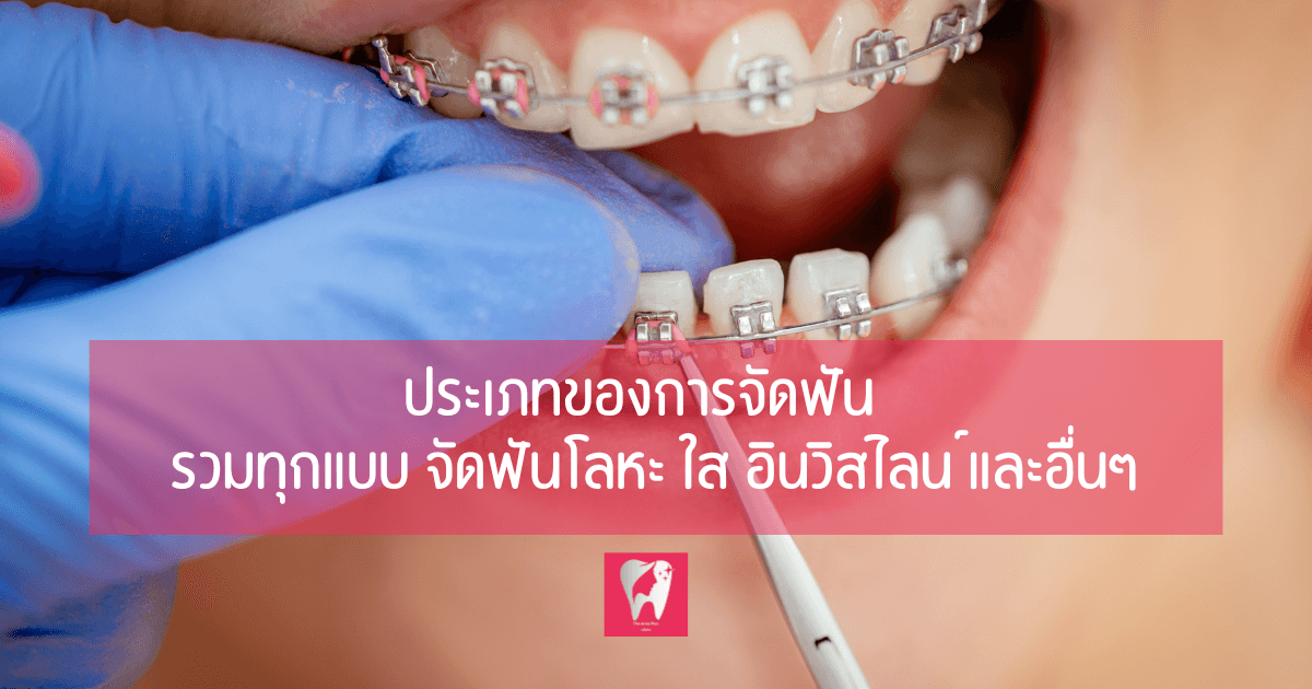 ภาพหัวข้อบทความ ประเภทของการจัดฟัน รวมทุกแบบ จัดฟันโลหะ จัดฟันใส อินวิสไลน์ และอื่นๆ บนภาพระยะใกล้ของเหล็กจัดฟัน