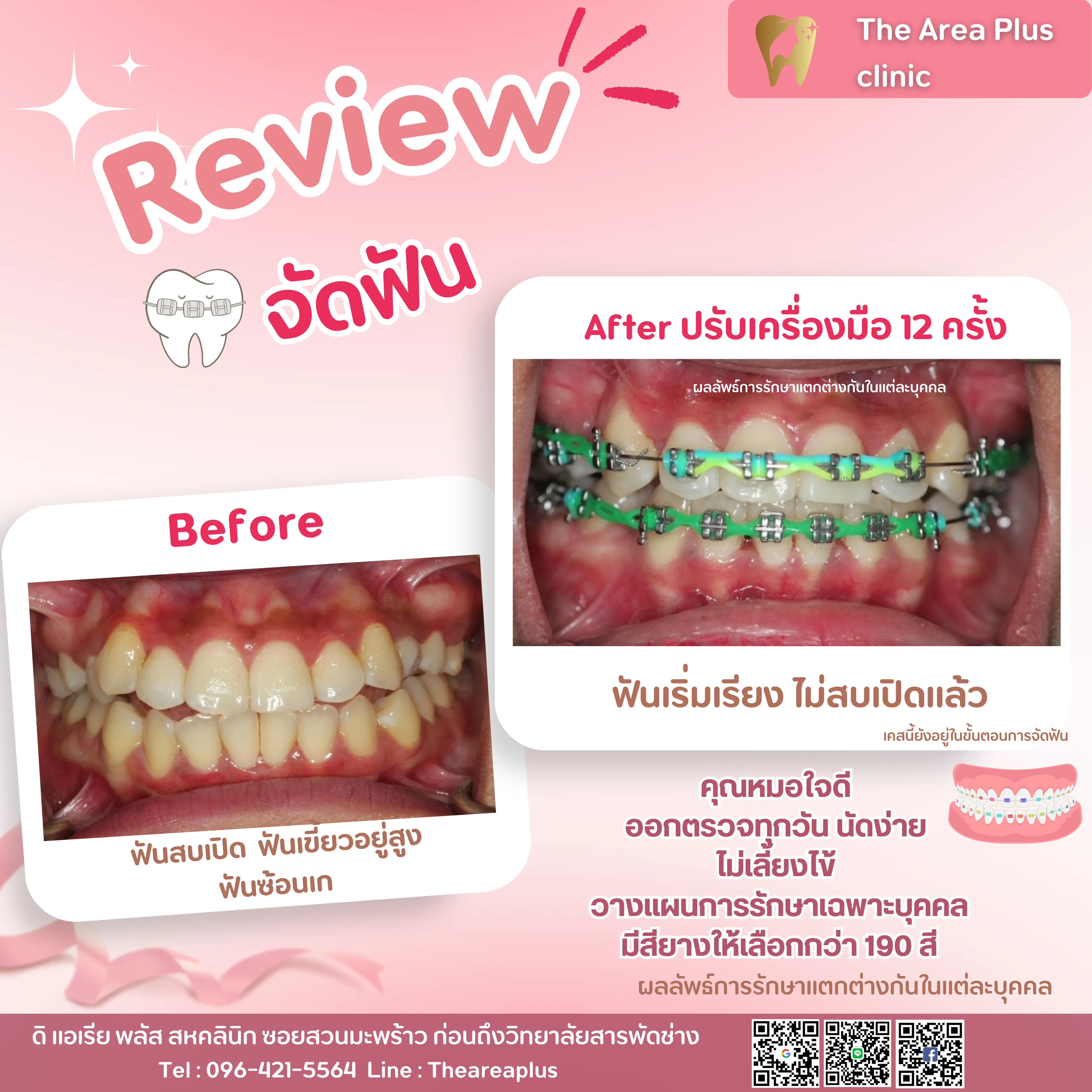 รีวิวจัดฟัน เคสฟันสบเปิด ฟันเขี้ยวอยู่สูงและฟันซ้อนเก เทียบภาพก่อนจัดฟันกับหลังปรับเครื่องมือ 12 ครั้ง มุมด้านหน้า
