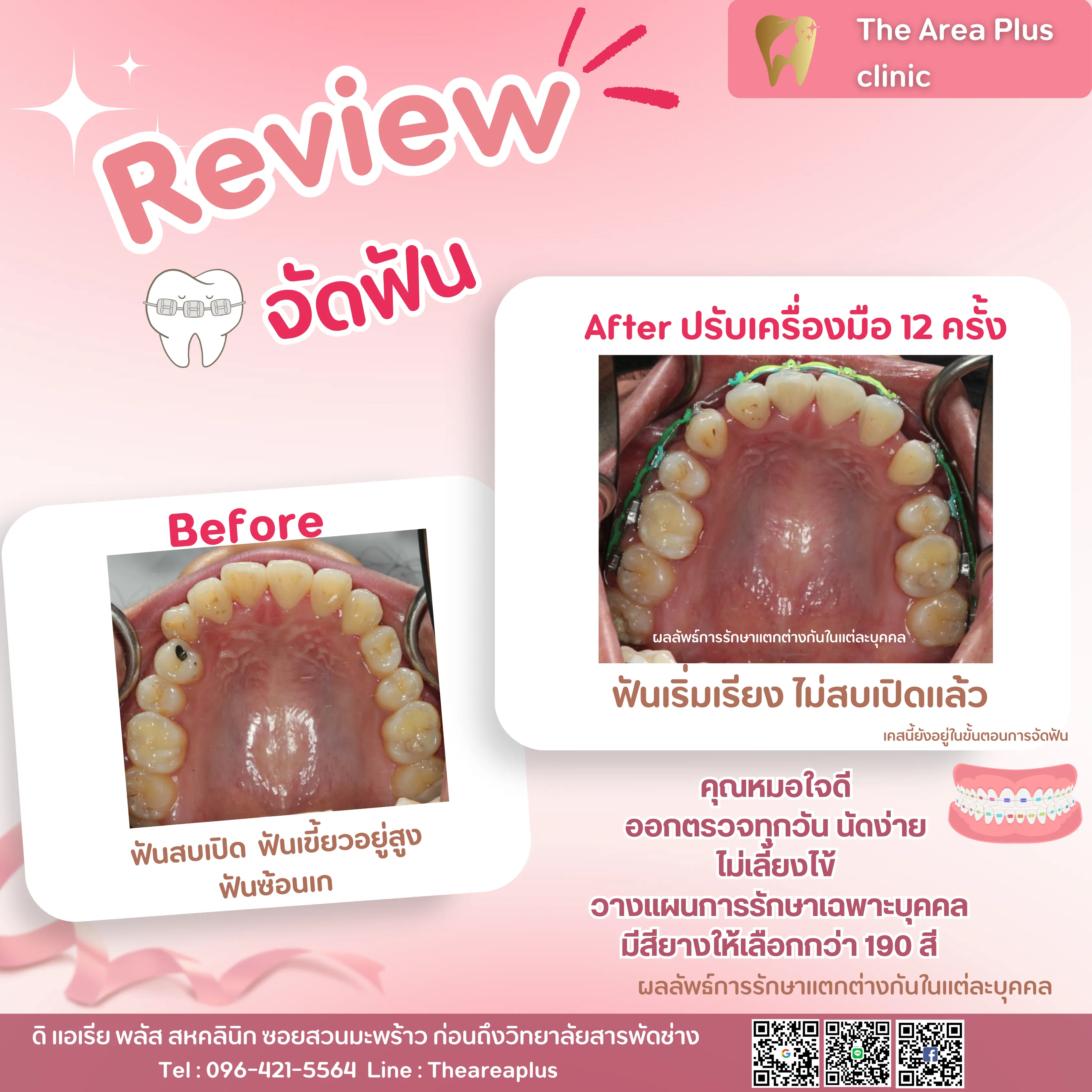 รีวิวจัดฟัน เคสฟันสบเปิด ฟันเขี้ยวอยู่สูงและฟันซ้อนเก เทียบภาพก่อนจัดฟันกับหลังปรับเครื่องมือ 12 ครั้ง มุมขากรรไกรบน