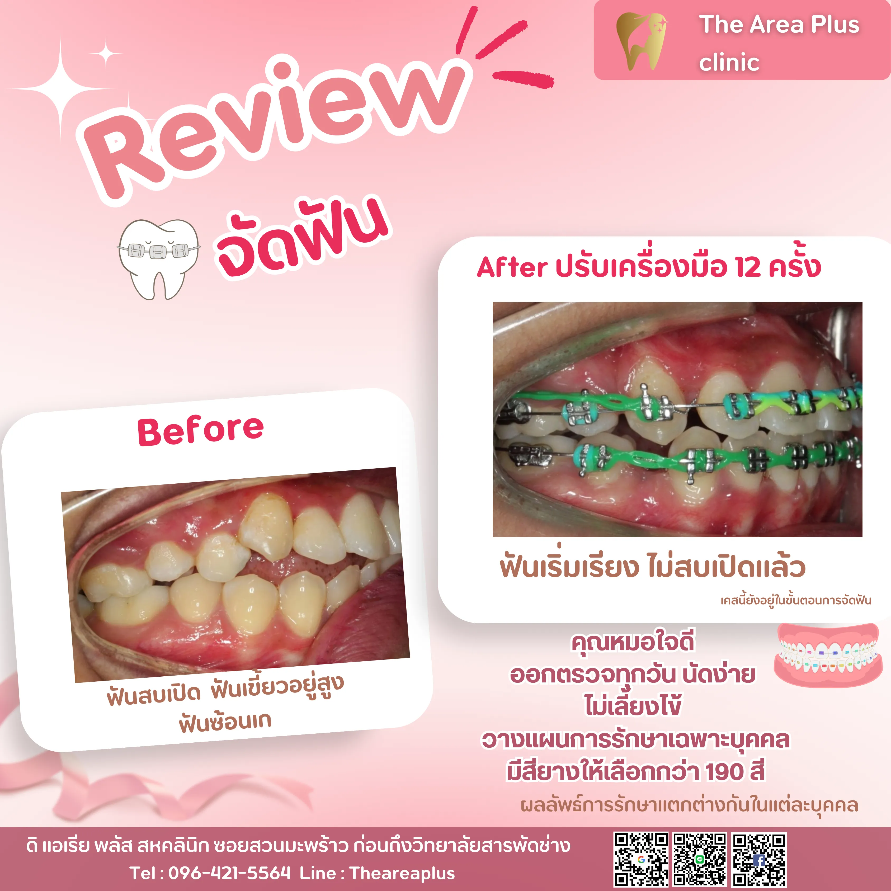 รีวิวจัดฟัน เคสฟันสบเปิด ฟันเขี้ยวอยู่สูงและฟันซ้อนเก เทียบภาพก่อนจัดฟันกับหลังปรับเครื่องมือ 12 ครั้ง มุมด้านข้างขวา