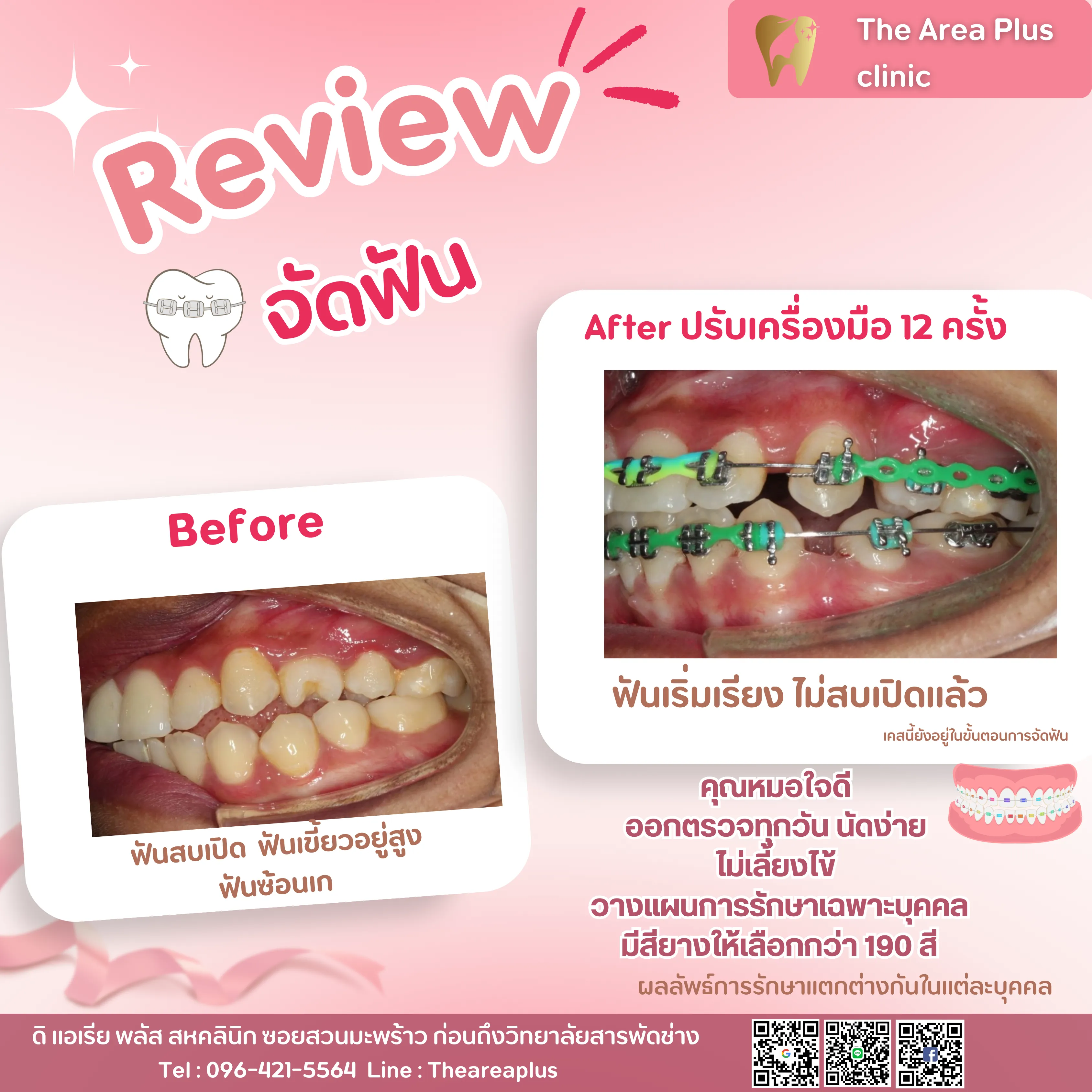 รีวิวจัดฟัน เคสฟันสบเปิด ฟันเขี้ยวอยู่สูงและฟันซ้อนเก เทียบภาพก่อนจัดฟันกับหลังปรับเครื่องมือ 12 ครั้ง มุมด้านข้างซ้าย