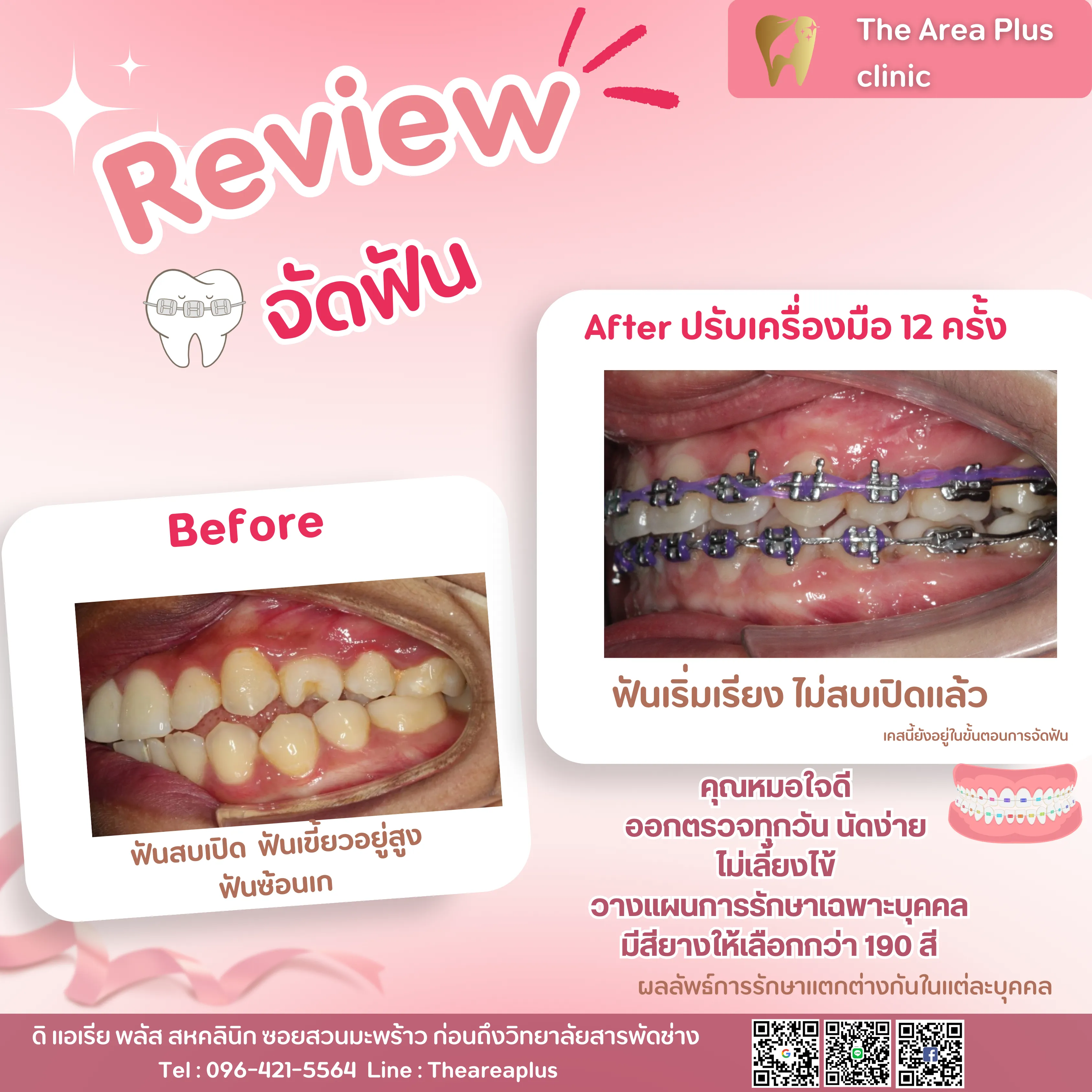รีวิวจัดฟัน เคสฟันสบเปิด ฟันเขี้ยวอยู่สูงและฟันซ้อนเก เทียบภาพก่อนจัดฟันกับหลังปรับเครื่องมือ 12 ครั้ง มุมด้านข้างพร้อมยางจัดฟันสีม่วง