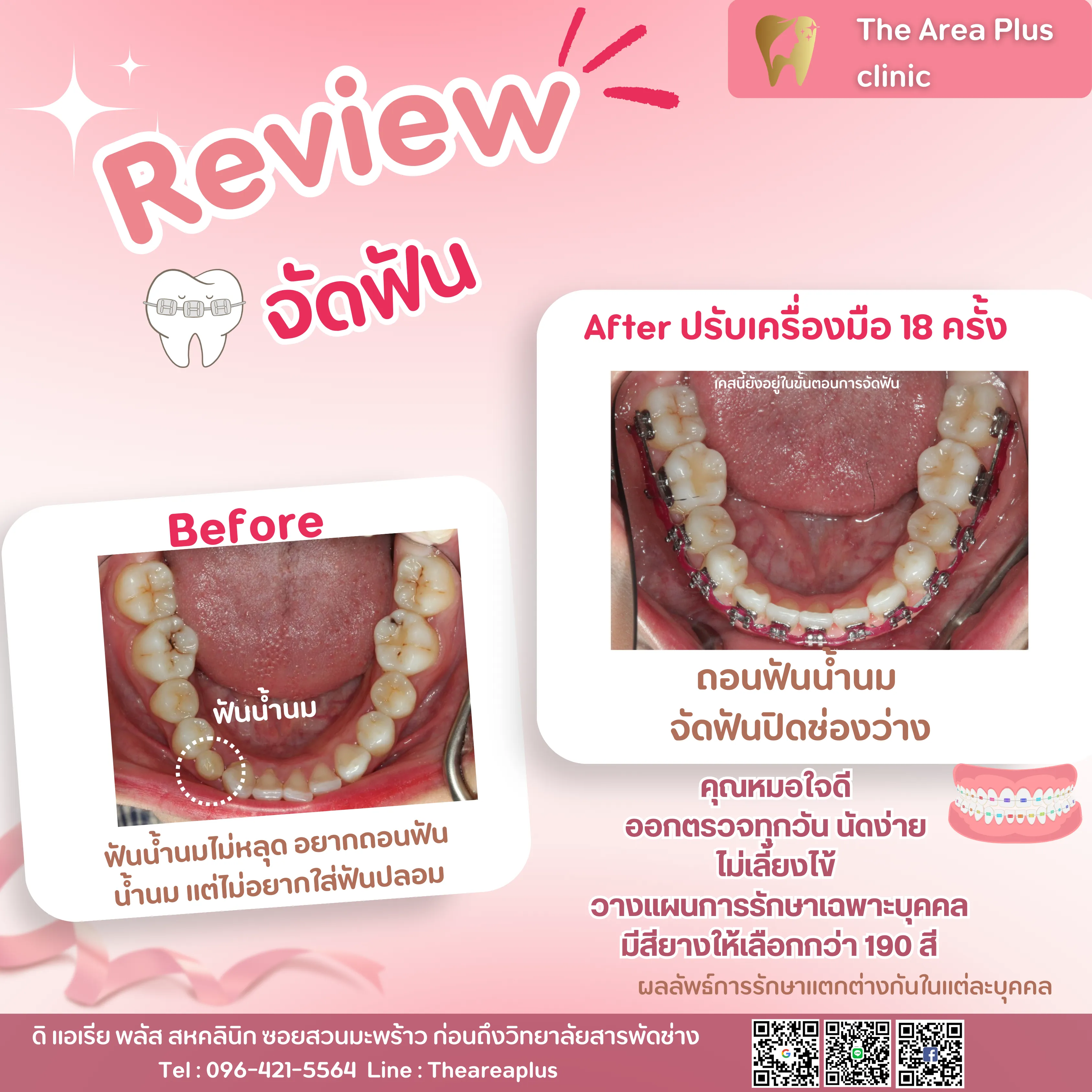 รีวิวจัดฟัน เคสฟันน้ำนมไม่หลุดโดยไม่ต้องใส่ฟันปลอม ถอนฟันน้ำนมแล้วจัดฟันปิดช่องว่าง เทียบก่อนจัดฟันกับหลังปรับเครื่องมือ 18 ครั้ง มุมขากรรไกรล่าง