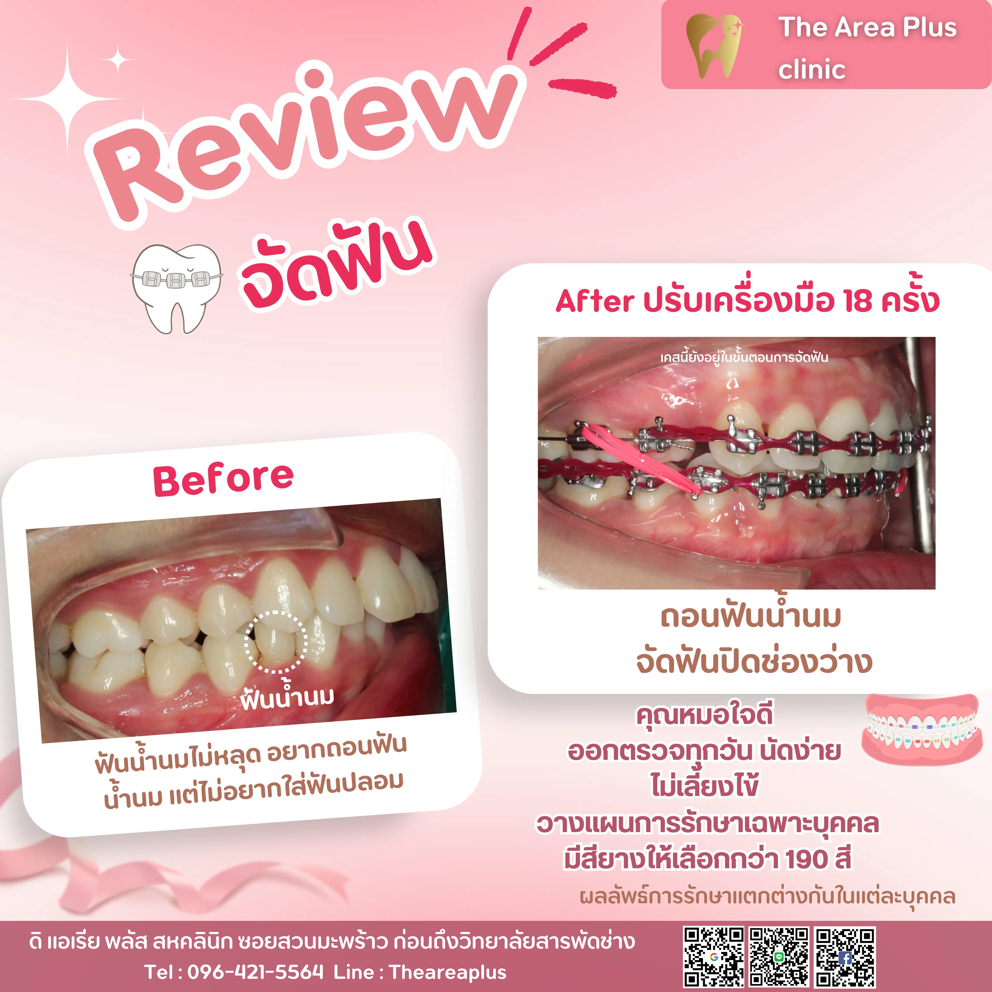 รีวิวจัดฟัน เคสฟันน้ำนมไม่หลุดโดยไม่ต้องใส่ฟันปลอม ถอนฟันน้ำนมแล้วจัดฟันปิดช่องว่าง เทียบก่อนจัดฟันกับหลังปรับเครื่องมือ 18 ครั้ง มุมด้านข้าง