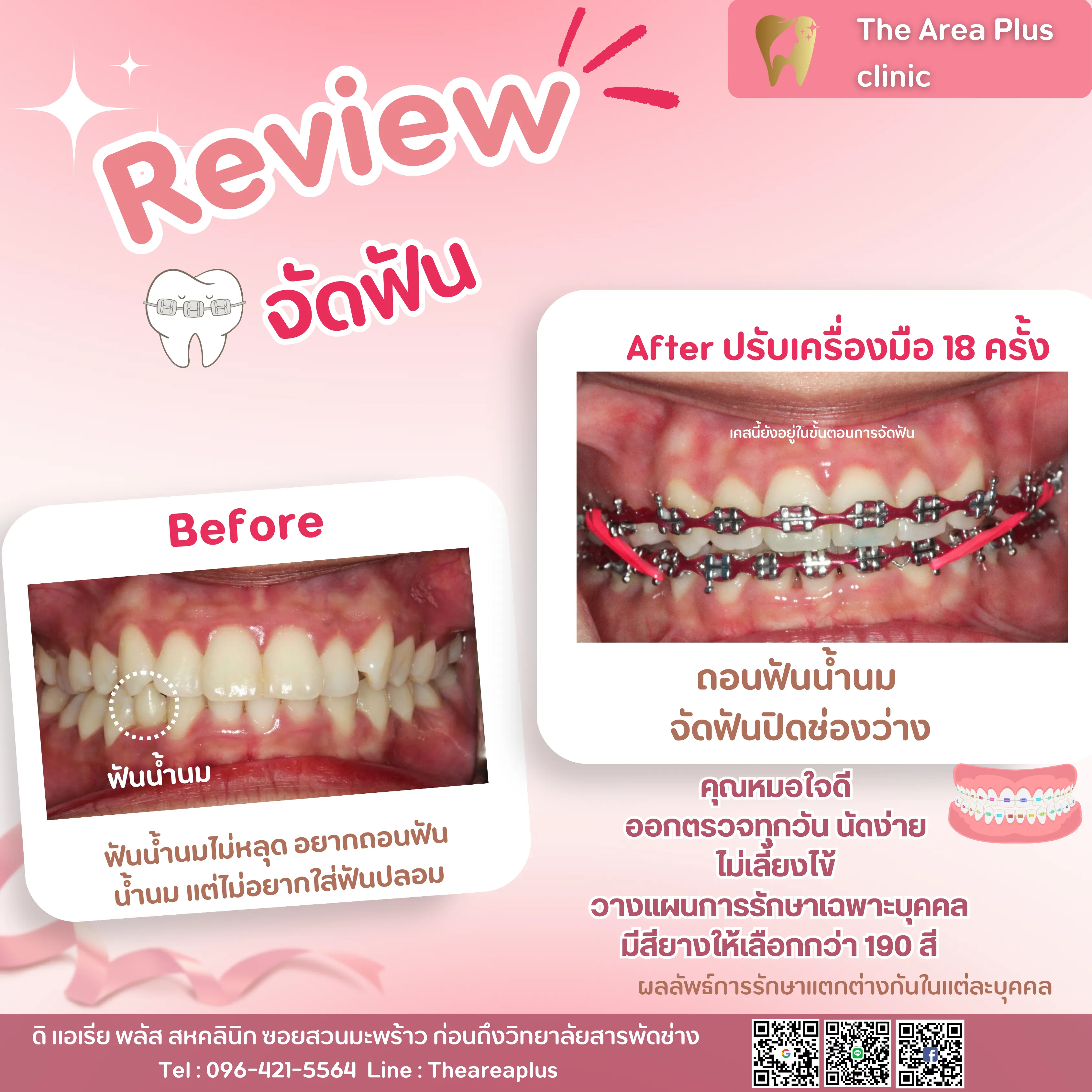 รีวิวจัดฟัน เคสฟันน้ำนมไม่หลุดโดยไม่ต้องใส่ฟันปลอม ถอนฟันน้ำนมแล้วจัดฟันปิดช่องว่าง เทียบก่อนจัดฟันกับหลังปรับเครื่องมือ 18 ครั้ง มุมด้านหน้า
