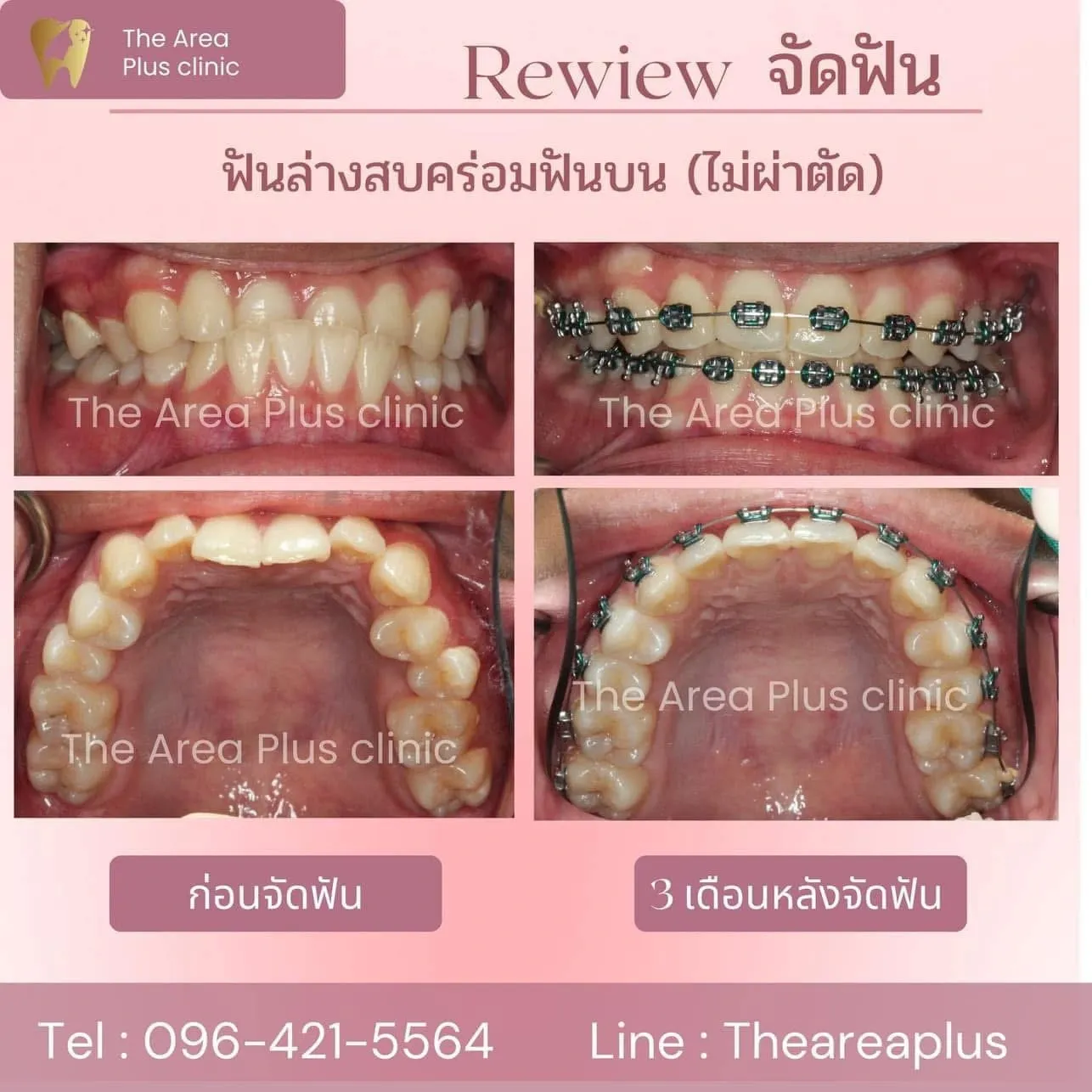 รีวิวจัดฟัน เคสฟันล่างสบคร่อมฟันบนโดยไม่ต้องผ่าตัด เทียบก่อนจัดฟันกับ 3 เดือนหลังจัดฟัน ทั้งมุมด้านหน้าและขากรรไกรบน