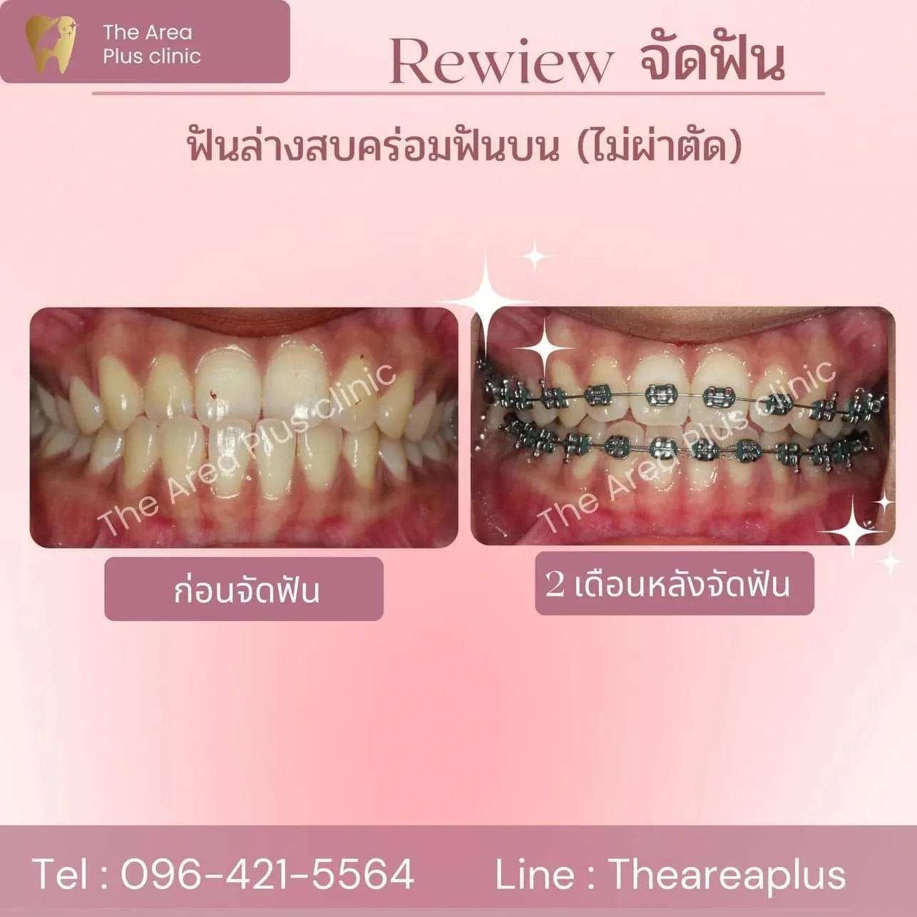 รีวิวจัดฟัน เคสฟันล่างสบคร่อมฟันบนโดยไม่ต้องผ่าตัด เทียบภาพก่อนจัดฟันกับ 2 เดือนหลังจัดฟัน