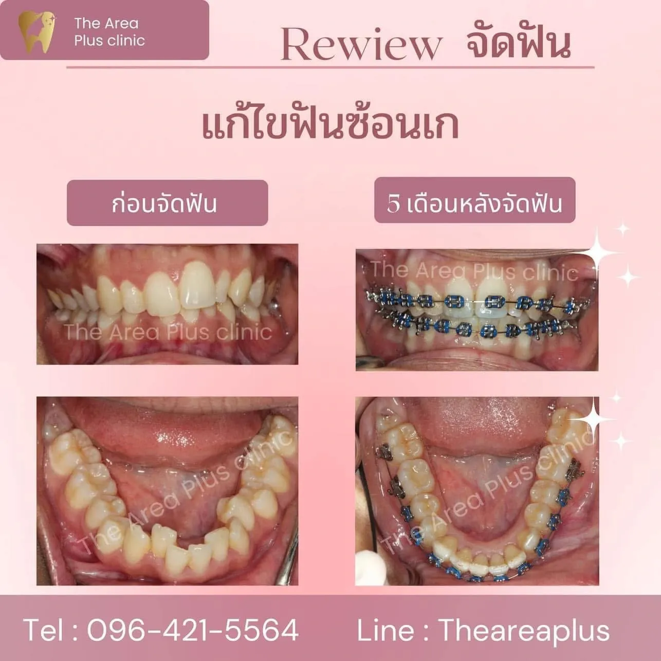 รีวิวจัดฟัน แก้ไขฟันซ้อนเก เทียบภาพก่อนจัดฟันกับ 5 เดือนหลังจัดฟัน ทั้งมุมด้านหน้าและขากรรไกรล่าง