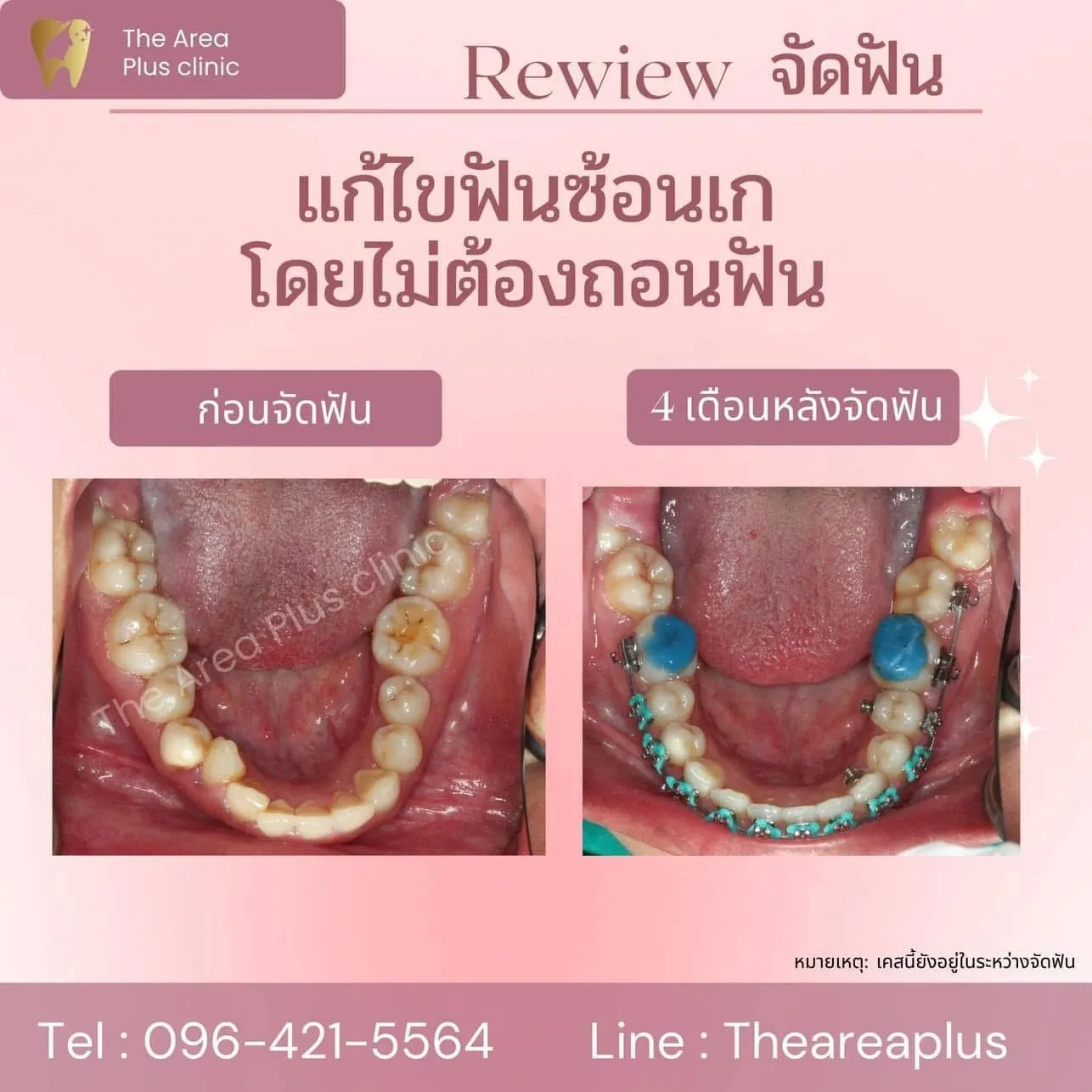 รีวิวจัดฟัน แก้ไขฟันซ้อนเกโดยไม่ต้องถอนฟัน เทียบภาพก่อนจัดฟันกับ 4 เดือนหลังจัดฟัน มุมขากรรไกรล่าง