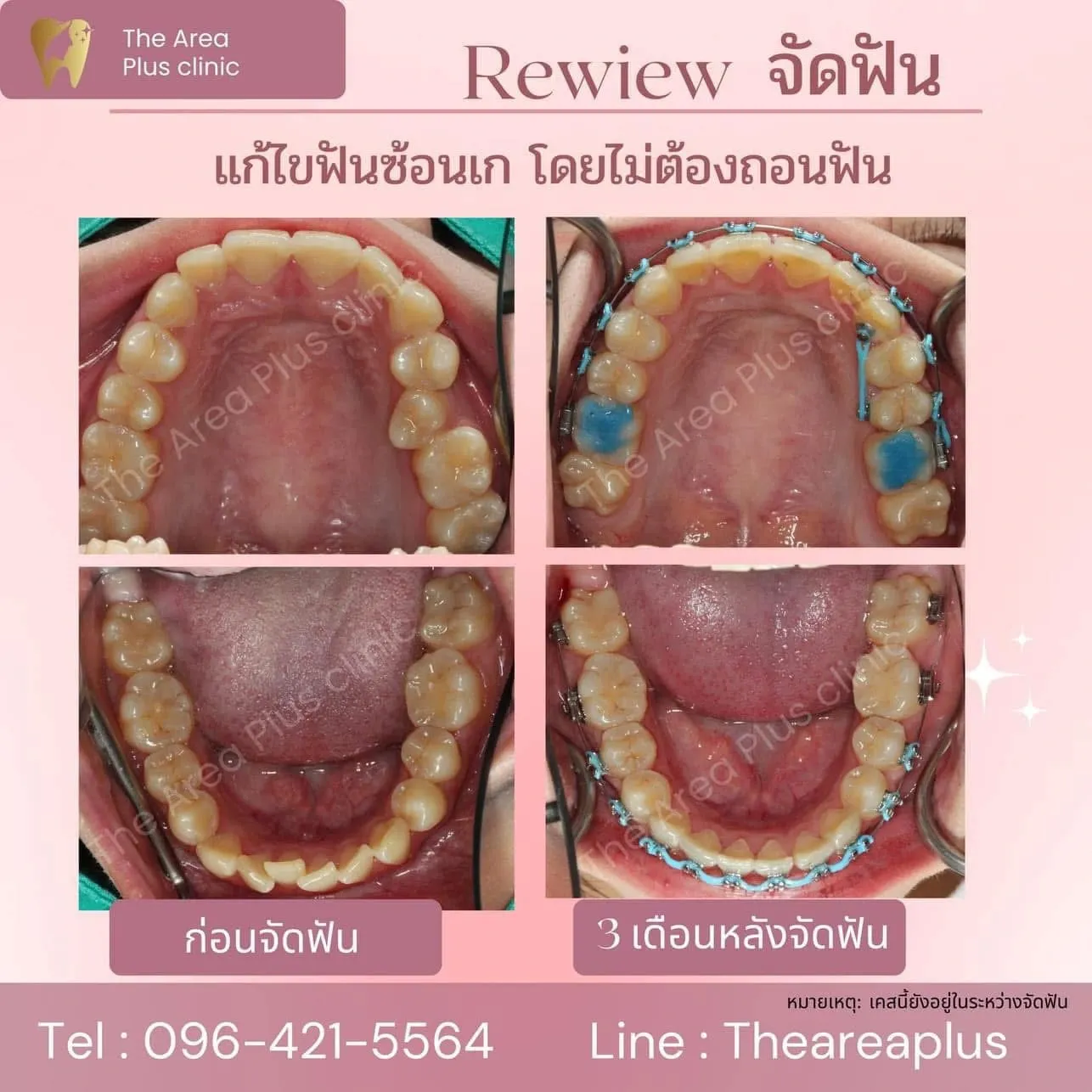 รีวิวจัดฟัน แก้ไขฟันซ้อนเกโดยไม่ต้องถอนฟัน เทียบภาพก่อนจัดฟันกับ 3 เดือนหลังจัดฟัน ทั้งขากรรไกรบนและล่าง