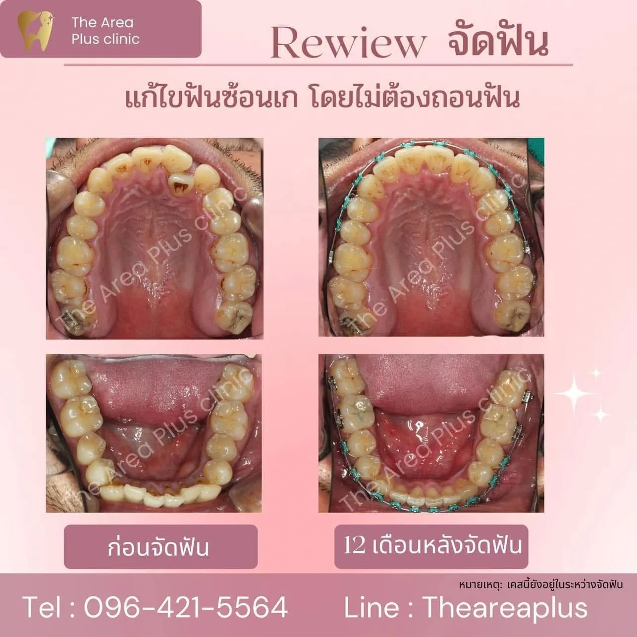 รีวิวจัดฟัน แก้ไขฟันซ้อนเกโดยไม่ต้องถอนฟัน เทียบภาพก่อนจัดฟันกับ 12 เดือนหลังจัดฟัน ทั้งขากรรไกรบนและล่าง