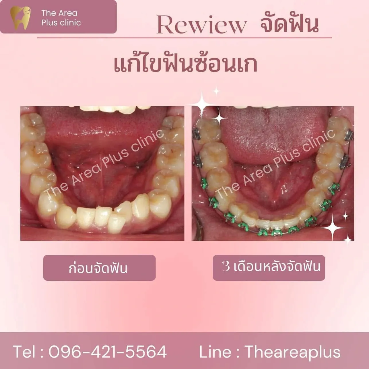 รีวิวจัดฟัน แก้ไขฟันซ้อนเก เทียบภาพก่อนจัดฟันกับ 3 เดือนหลังจัดฟัน มุมขากรรไกรล่าง