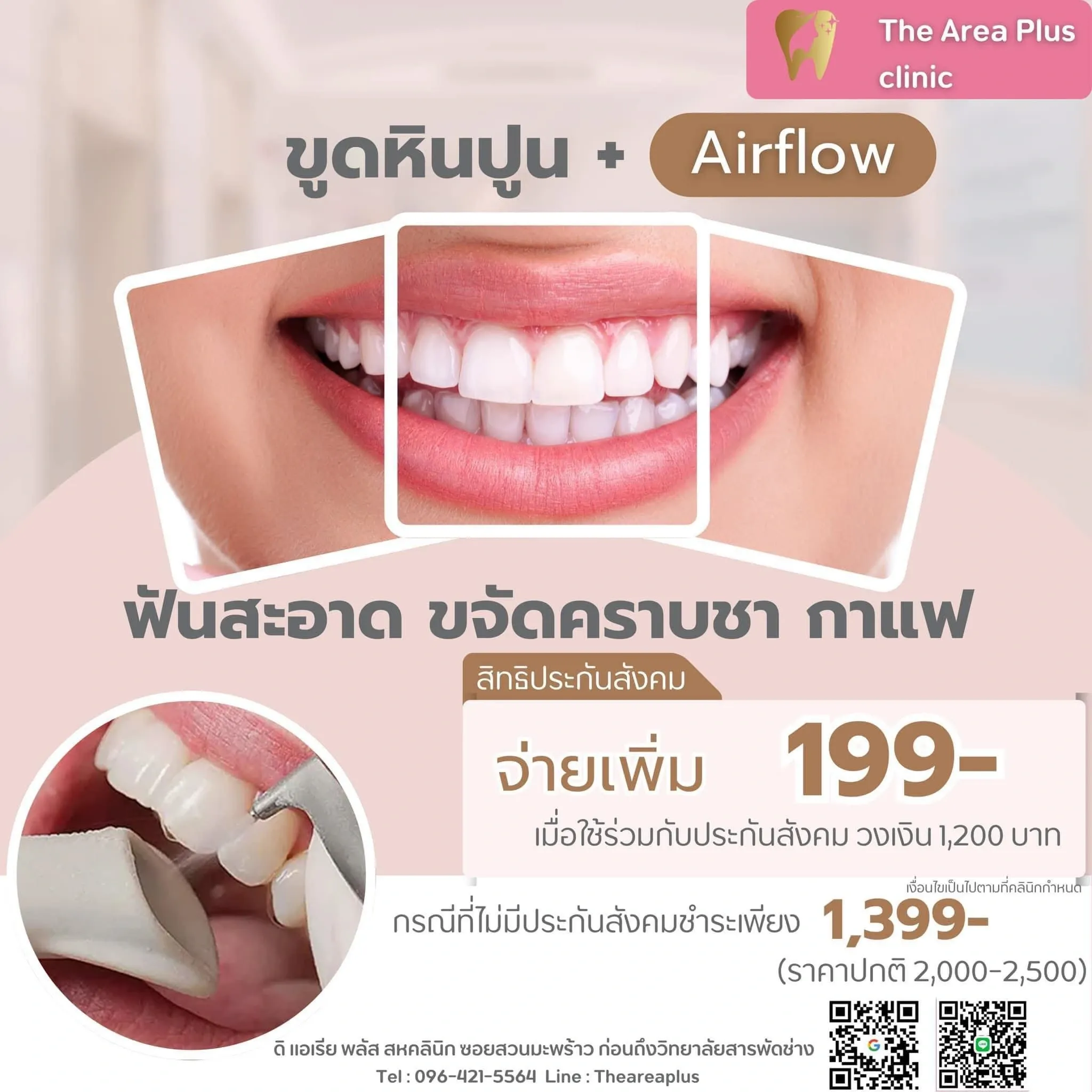 ภาพโปรโมชันขูดหินปูนพร้อม Airflow ขจัดคราบชาและกาแฟ จ่ายเพิ่ม 199 บาทเมื่อใช้สิทธิประกันสังคม หรือ 1,399 บาทกรณีไม่มีสิทธิ