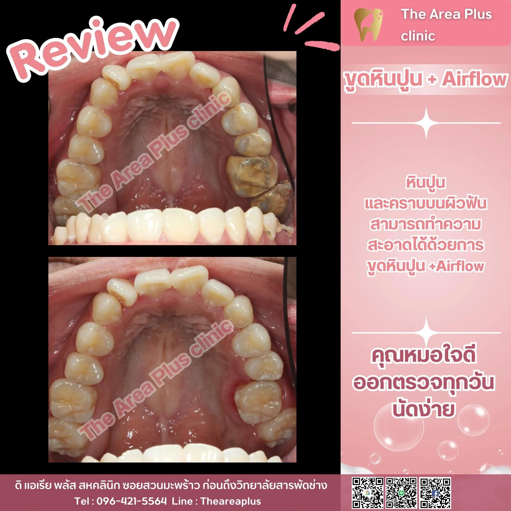 รีวิวขูดหินปูนและ Airflow เทียบภาพก่อนและหลังทำความสะอาดฟัน มุมขากรรไกรบน ถ่ายจากด้านบน