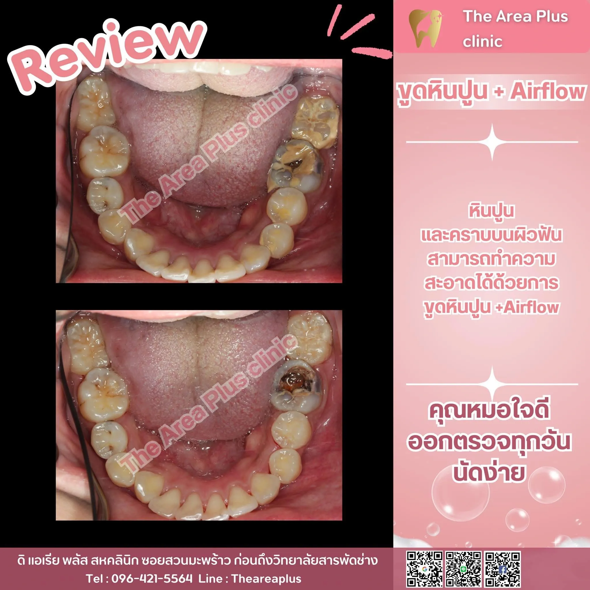 รีวิวขูดหินปูนและ Airflow เทียบภาพก่อนและหลังทำความสะอาดฟัน มุมขากรรไกรล่าง ถ่ายจากด้านบน