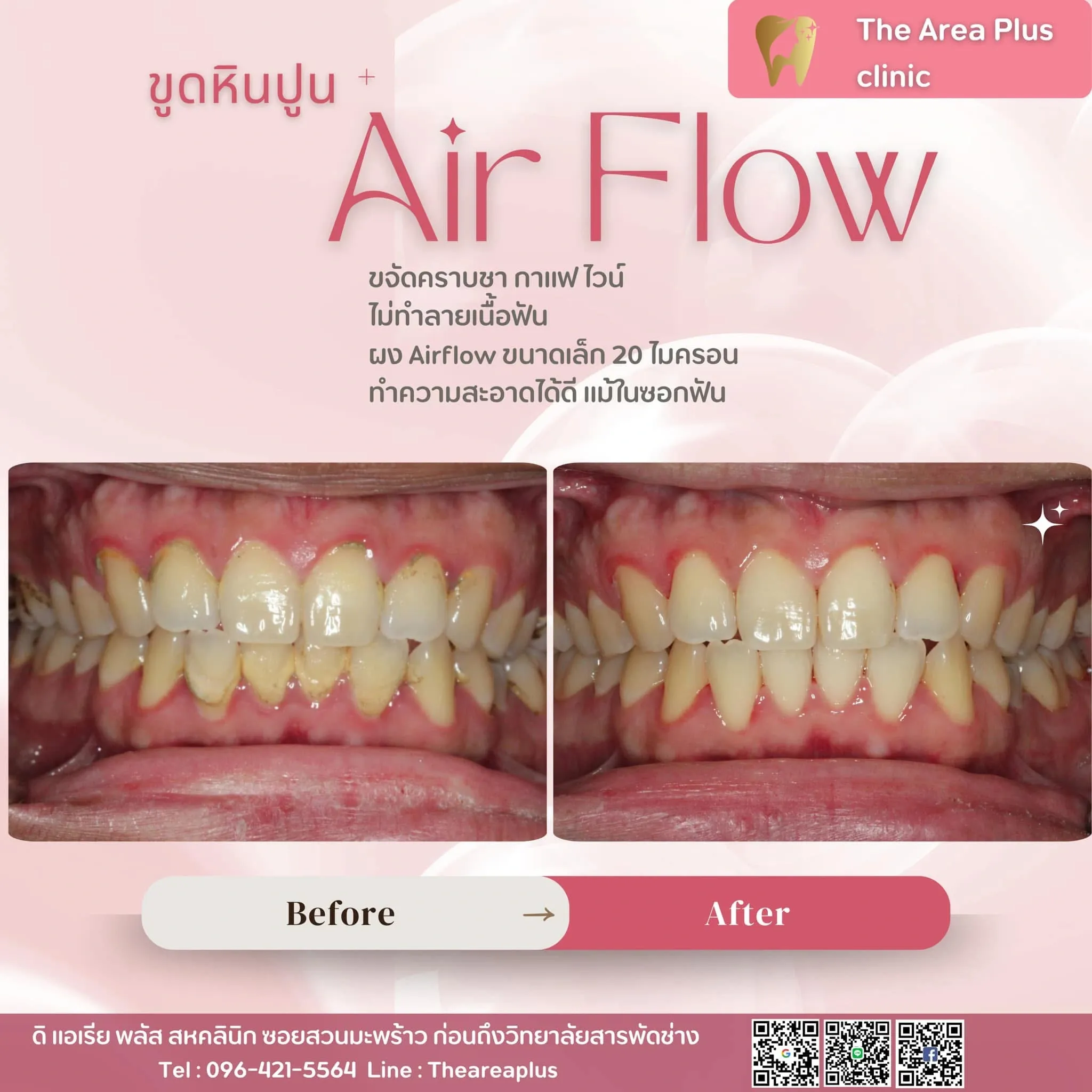 รีวิวขูดหินปูนและ Airflow เทียบภาพก่อนและหลังทำความสะอาดฟัน มุมฟันหน้าเมื่อสบฟัน เห็นคราบที่ขอบเหงือกหายไป