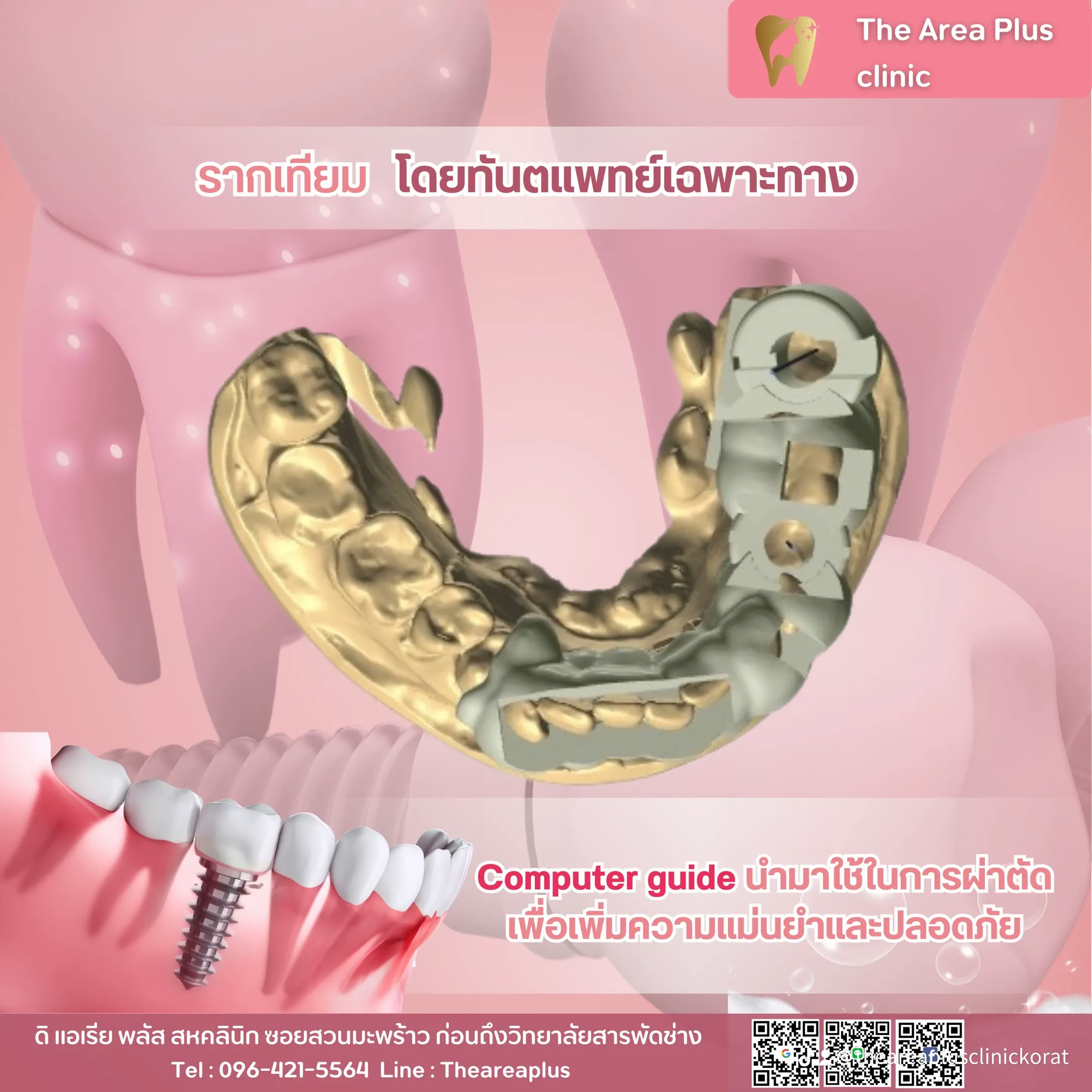 ภาพจำลองสามมิติของอุปกรณ์ Computer guide สำหรับกำหนดตำแหน่งฝังรากฟันเทียมให้แม่นยำและปลอดภัย