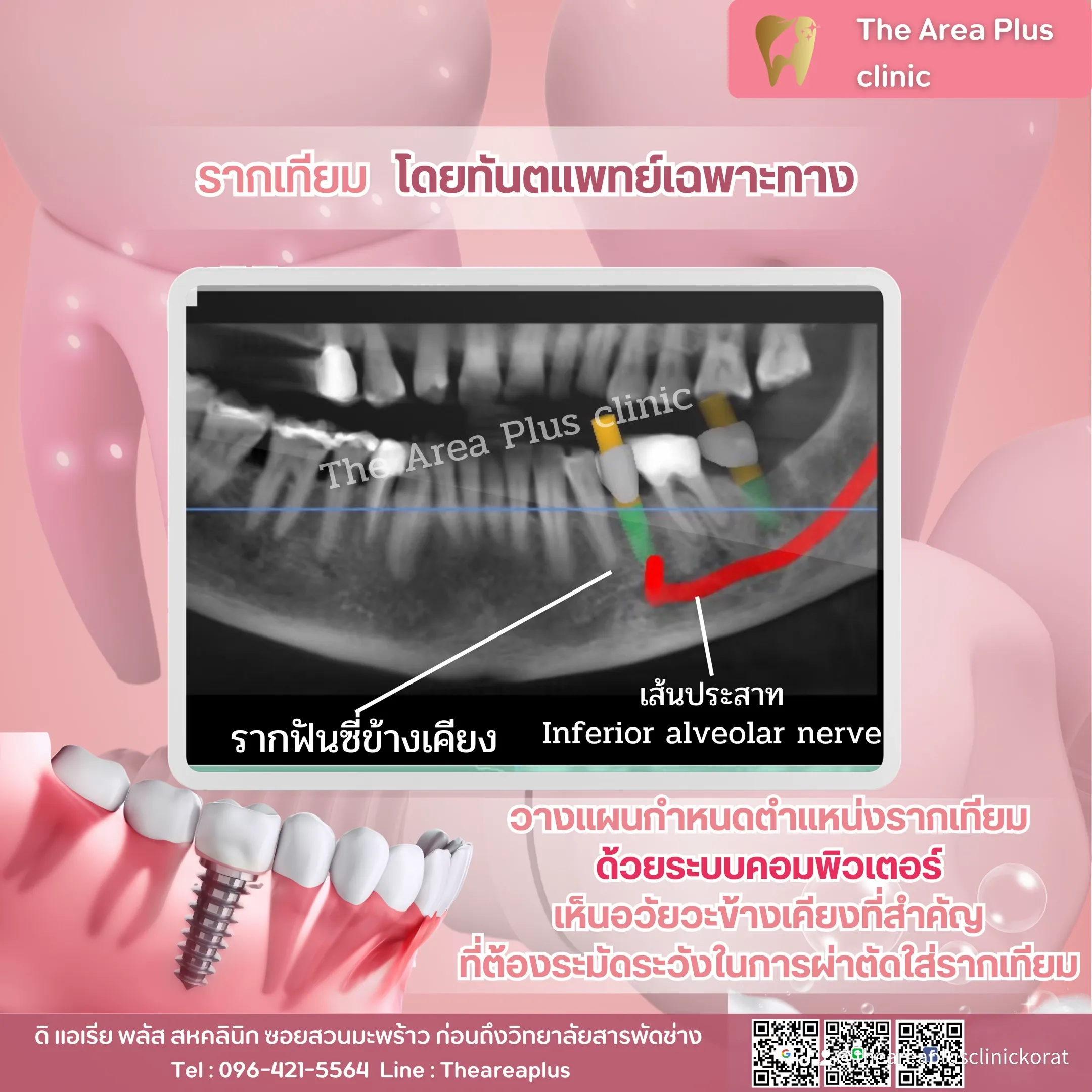 ฟิล์มเอกซเรย์วางแผนรากฟันเทียมด้วยระบบคอมพิวเตอร์ ทำเครื่องหมายตำแหน่งเส้นประสาท Inferior alveolar nerve และรากฟันซี่ข้างเคียง
