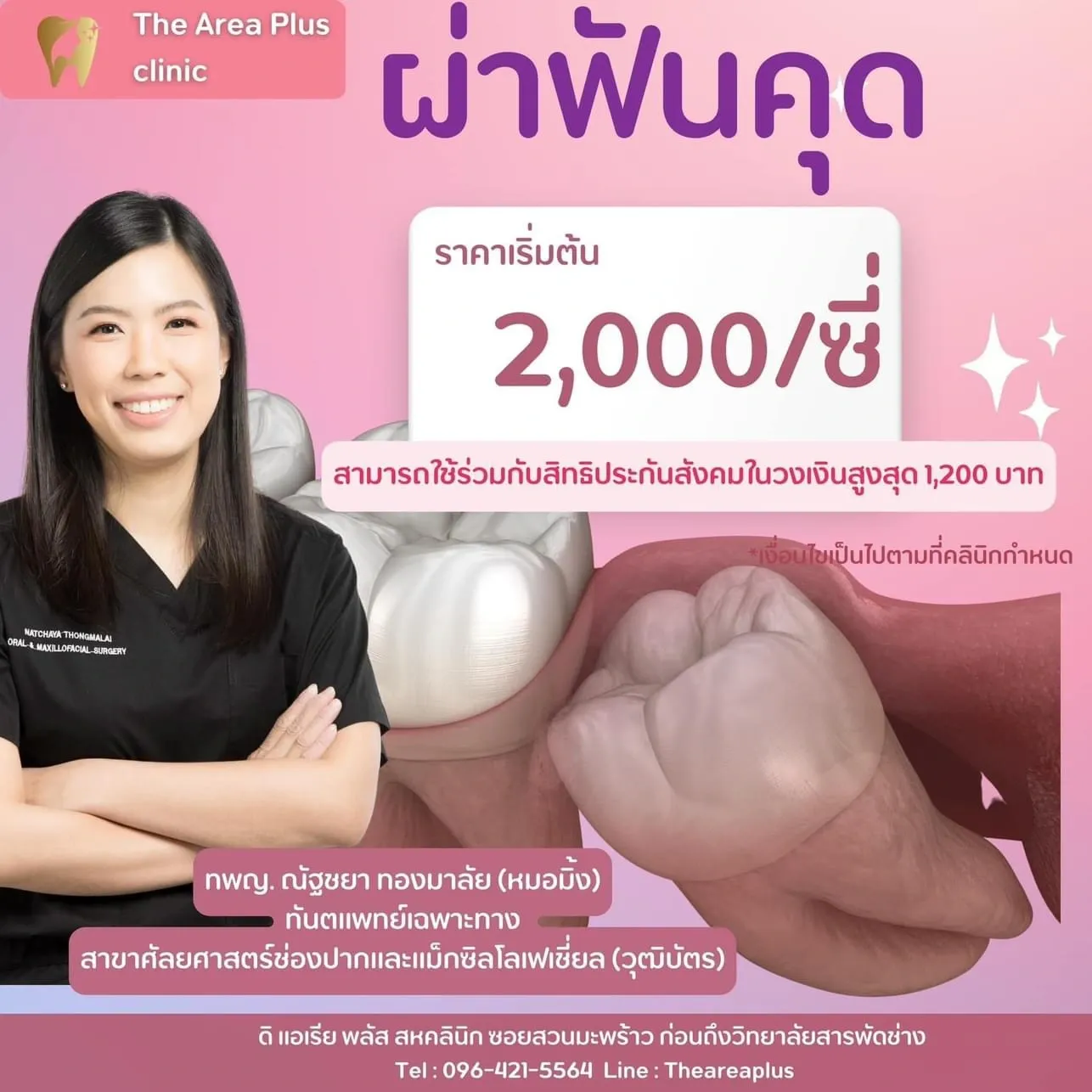 ภาพโปรโมชันผ่าฟันคุด ราคาเริ่มต้น 2,000 บาทต่อซี่ ใช้ร่วมกับสิทธิประกันสังคมได้สูงสุด 1,200 บาท โดย ทพญ.ณัฐชยา ทองมาลัย (หมอมิ้ง) พร้อมภาพจำลองฟันคุดที่เอียงชนฟันข้างเคียง