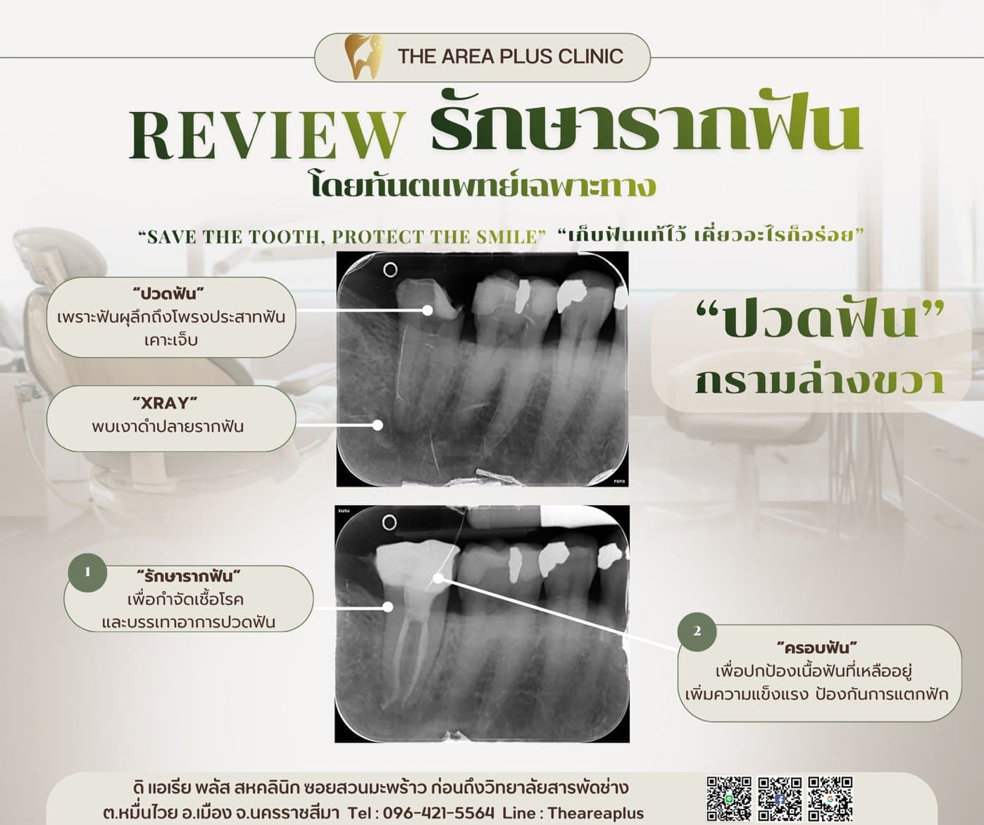 การ์ดรีวิวการรักษารากฟันกรามล่างขวา เทียบฟิล์มเอกซเรย์ก่อนและหลัง พร้อมอธิบายขั้นตอนรักษารากฟันและครอบฟัน