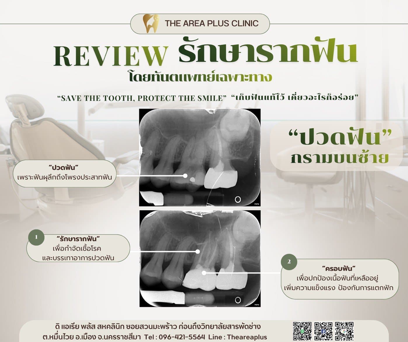การ์ดรีวิวรักษารากฟันกรามบนซ้ายโดยทันตแพทย์เฉพาะทาง เทียบฟิล์มเอกซเรย์ก่อนและหลังรักษารากฟันและครอบฟัน