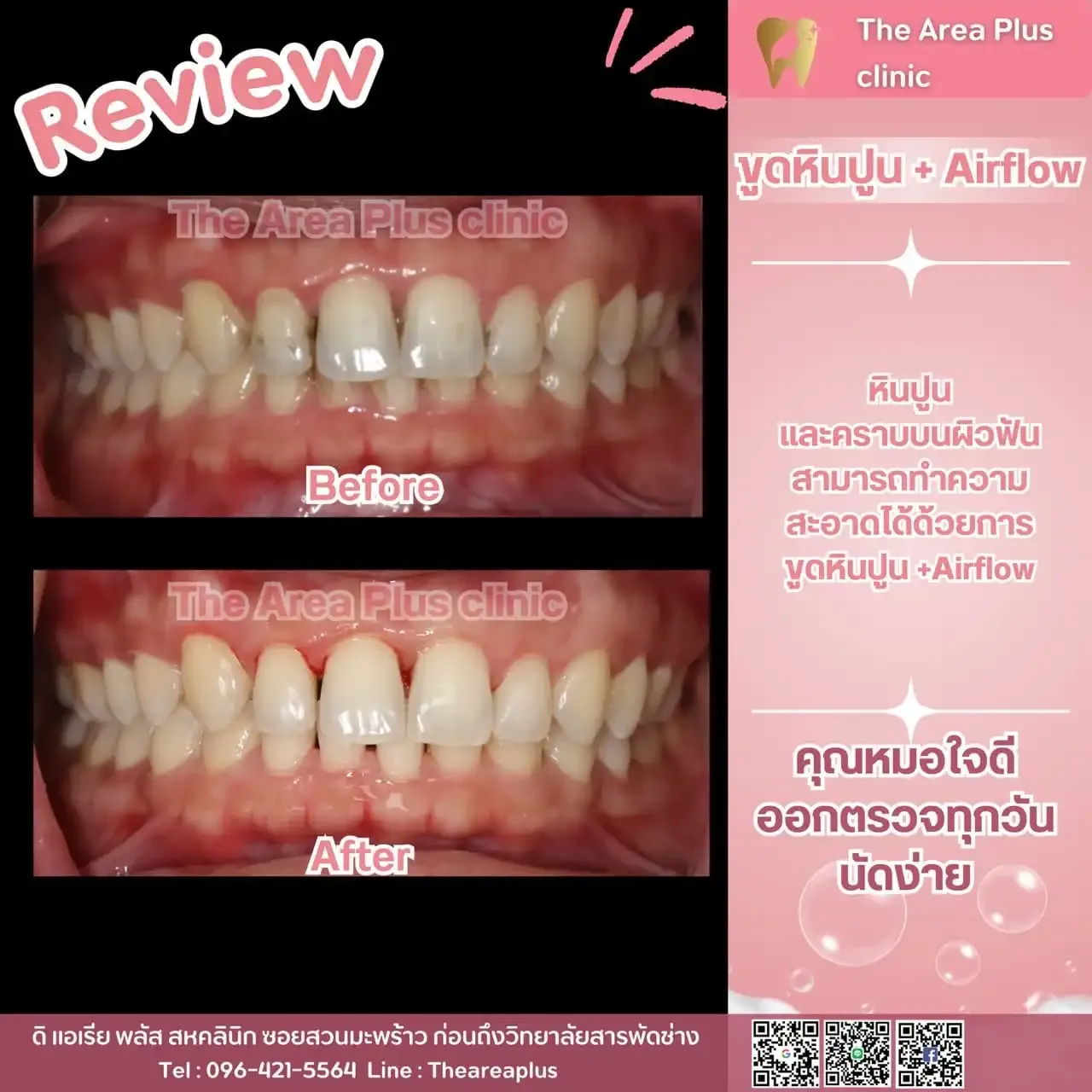 รีวิวขูดหินปูนและ Airflow เทียบภาพฟันก่อนและหลังทำความสะอาด เห็นคราบหินปูนที่คอฟันหายไป