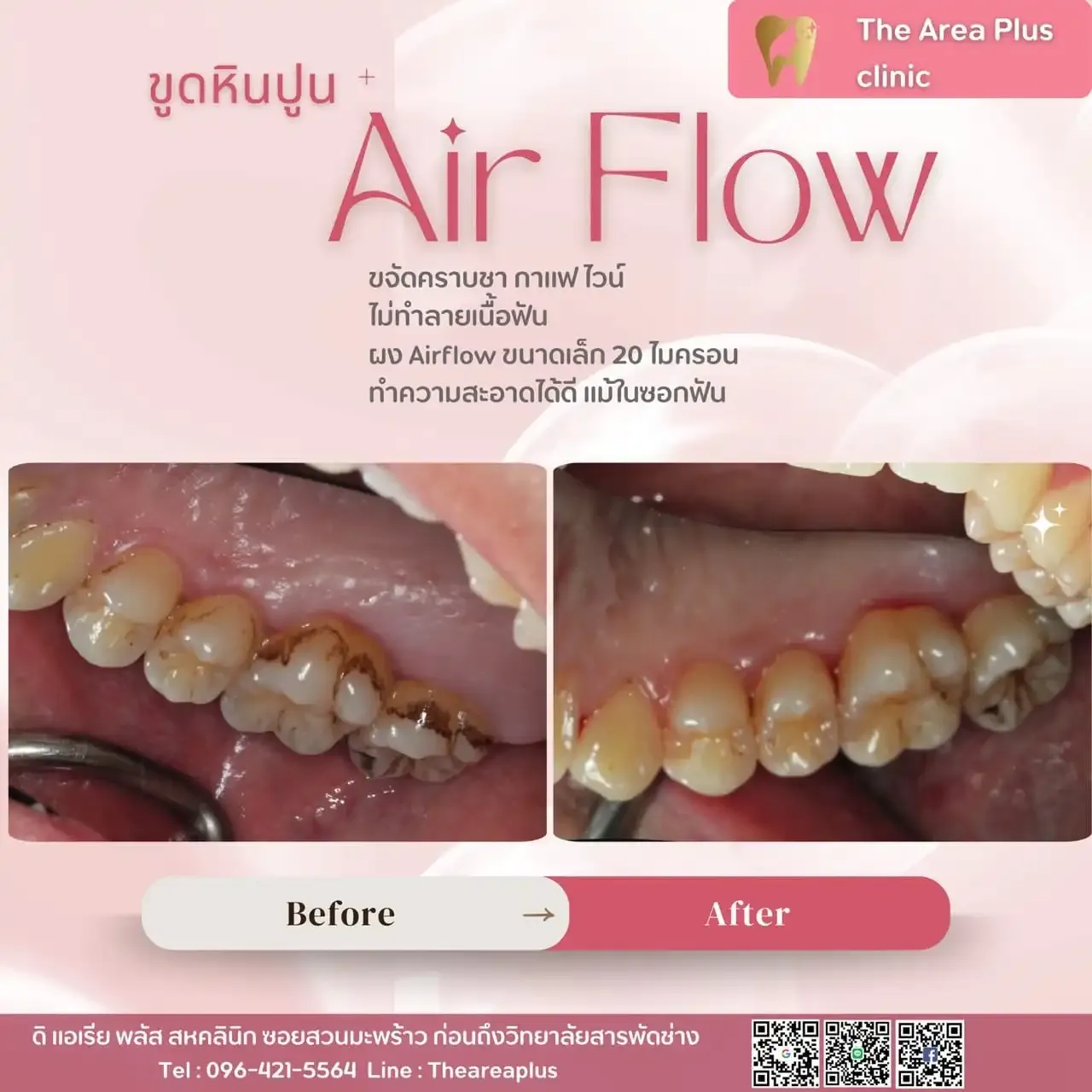 รีวิวขูดหินปูนและ Airflow เทียบภาพก่อนและหลังทำความสะอาดฟัน มุมฟันกรามด้านขวา เห็นคราบหินปูนสีน้ำตาลที่คอฟันหายไป