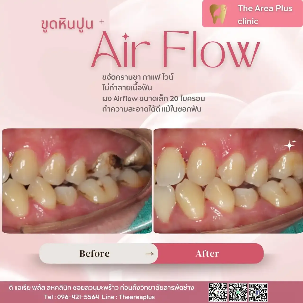 รีวิวขูดหินปูนและ Airflow เทียบภาพก่อนและหลังทำความสะอาดฟัน มุมฟันกรามด้านซ้าย เห็นคราบหินปูนระหว่างซอกฟันหายไป
