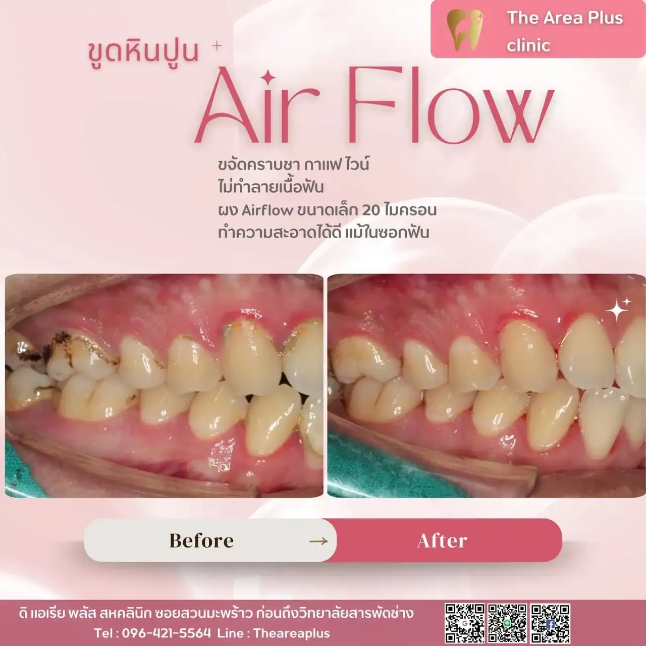 รีวิวขูดหินปูนและ Airflow เทียบภาพก่อนและหลังทำความสะอาดฟัน มุมฟันกรามล่าง เห็นคราบหินปูนที่ขอบเหงือกหายไป