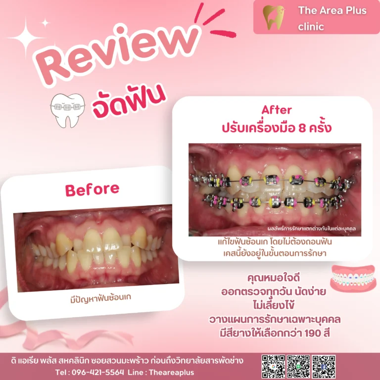 คลินิกทันตกรรมเฉพาะทางโคราช รีวิวจัดฟัน แก้ไขฟันซ้อนเก โดยไม่ต้องถอนฟัน