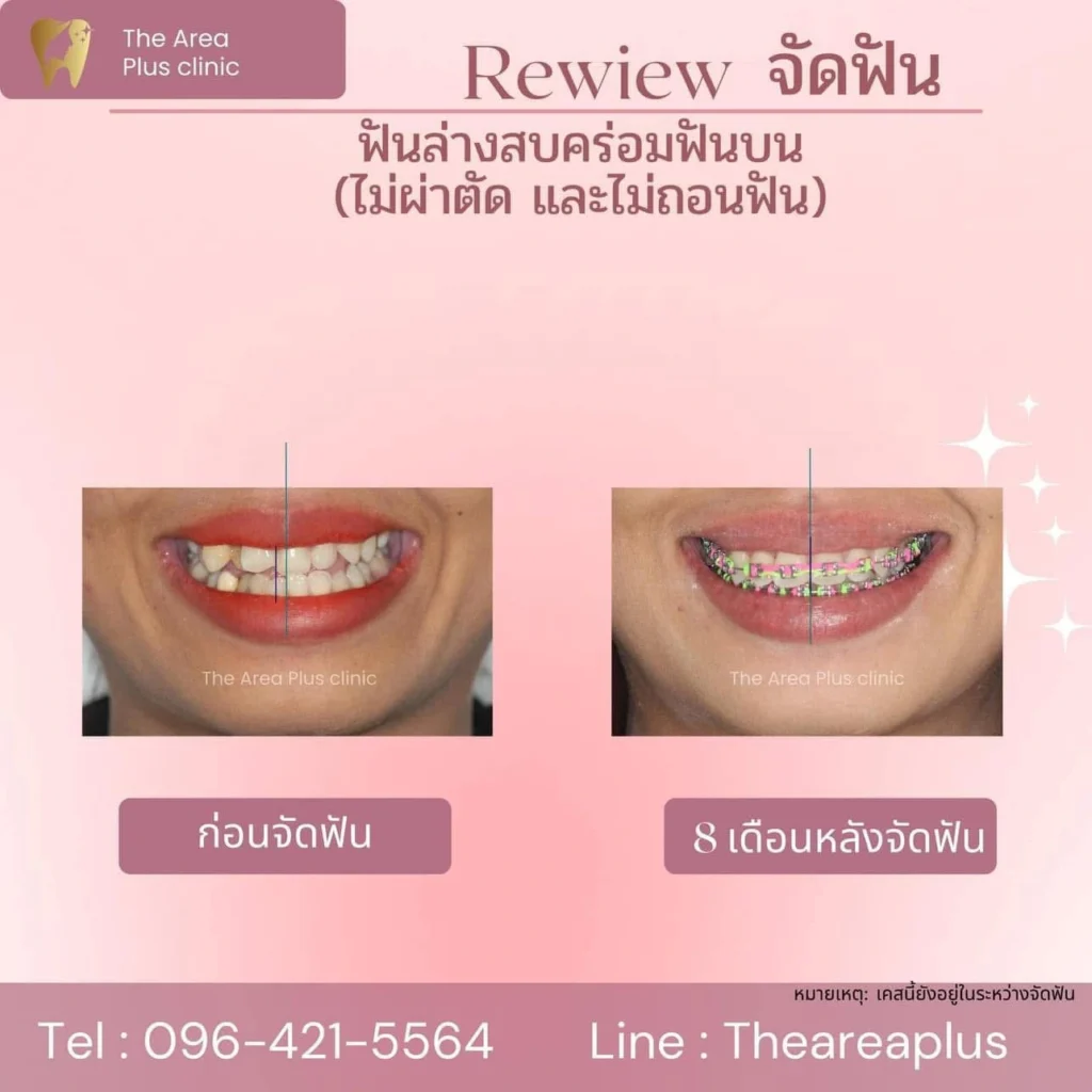 จัดฟันแบบโลหะ 11