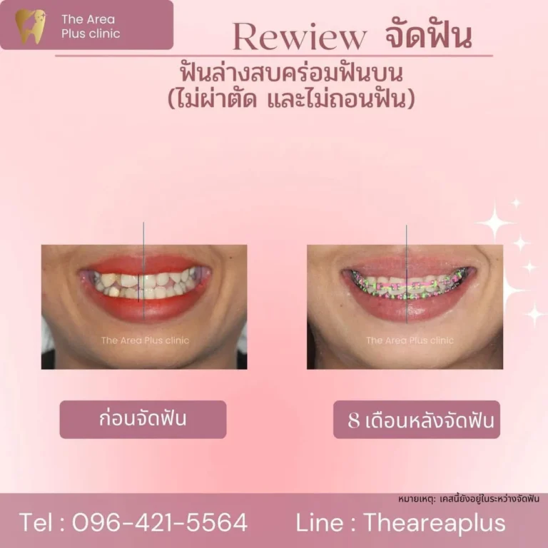 คลินิกทันตกรรมเฉพาะทางโคราช รีวิวจัดฟันฟันล่างครอบฟันบน