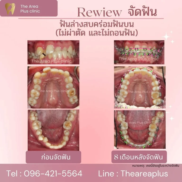 คลินิกทันตกรรมเฉพาะทางโคราช รีวิวจัดฟันฟันล่างครอบฟันบน