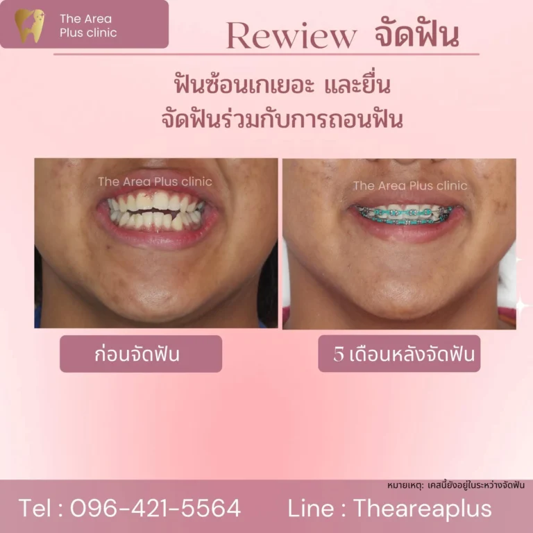 คลินิกทันตกรรมเฉพาะทางโคราช รีวิวจัดฟันแบบต้องถอนฟัน