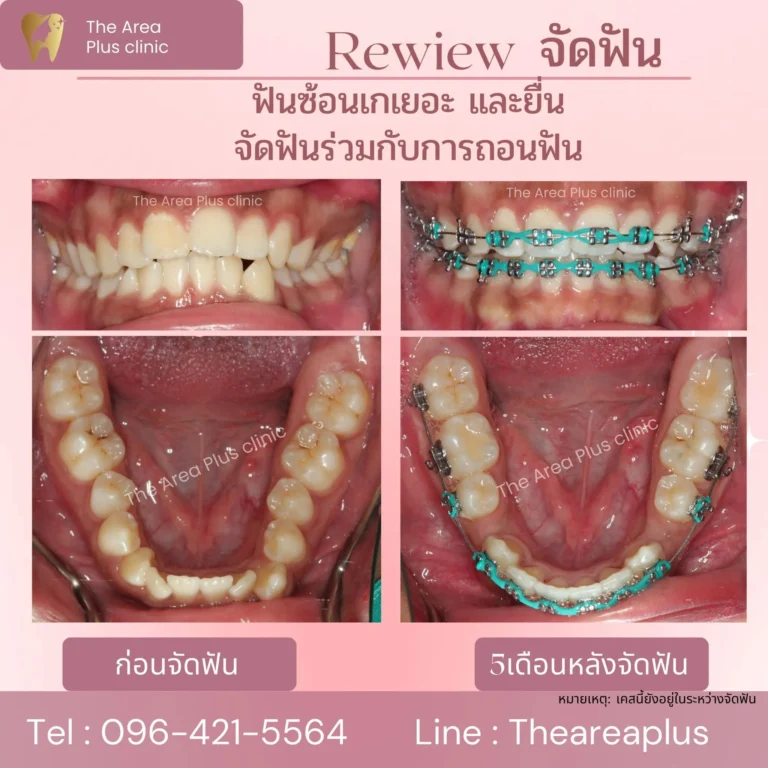 คลินิกทันตกรรมเฉพาะทางโคราช รีวิวจัดฟันแบบต้องถอนฟัน