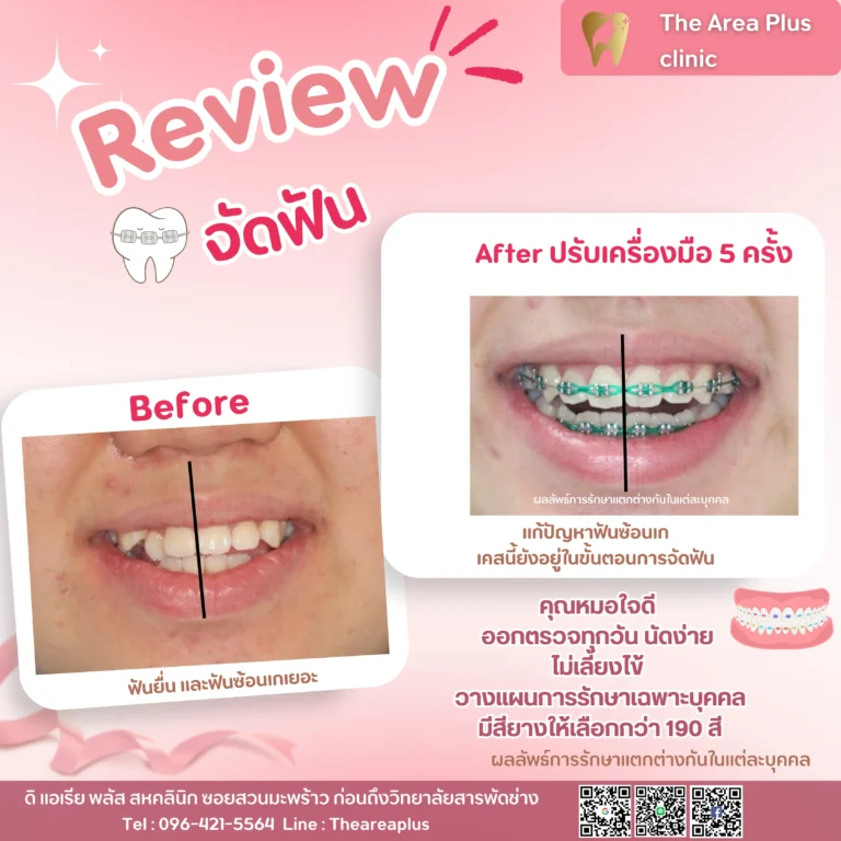 คลินิกทันตกรรมเฉพาะทางโคราช จัดฟันโคราชที่ไหนดี