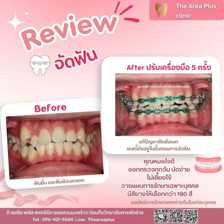 คลินิกทันตกรรมเฉพาะทางโคราช รีวิวจัดฟันหลังจาก 5 ครั้ง