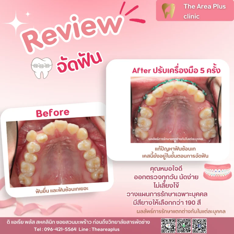 คลินิกทันตกรรมเฉพาะทางโคราช รีวิวจัดฟันหลังจาก 5 ครั้ง