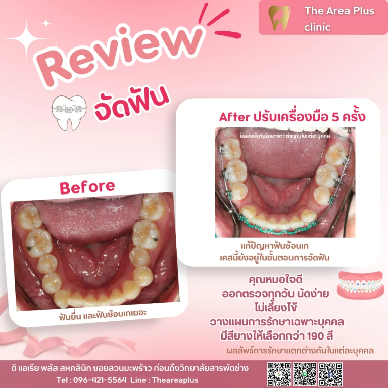 คลินิกทันตกรรมเฉพาะทางโคราช รีวิวจัดฟันหลังจาก 5 ครั้ง