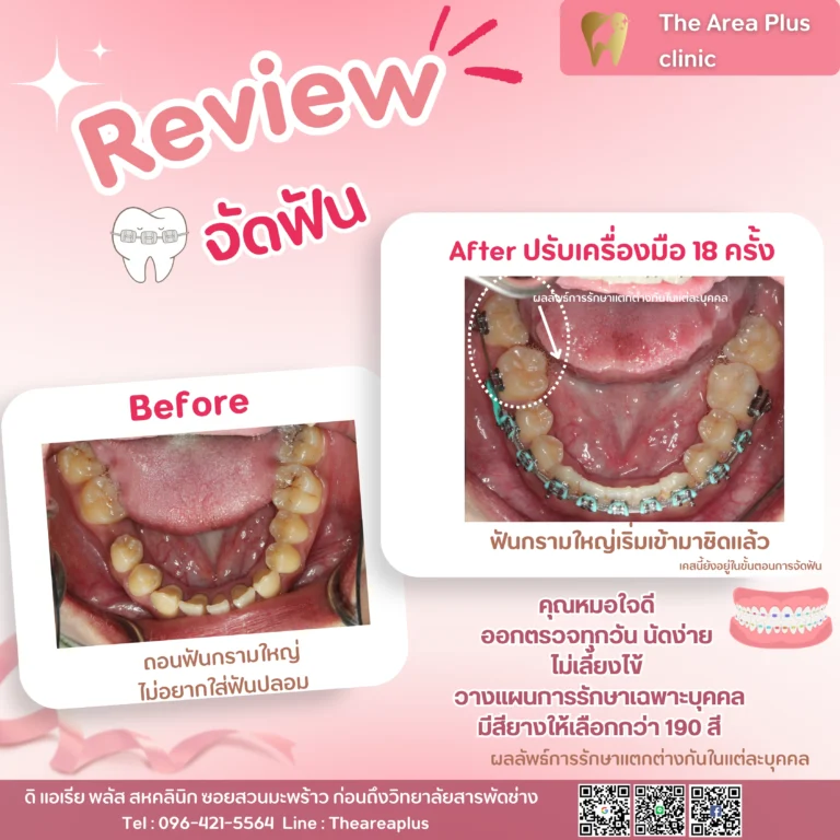 คลินิกทันตกรรมเฉพาะทางโคราช รีวิวจัดฟัน ฟันกรามใหญ่