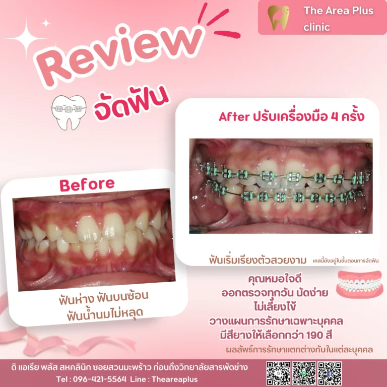 คลินิกทันตกรรมเฉพาะทางโคราช รีวิวจัดฟันหลังจาก 4 ครั้ง