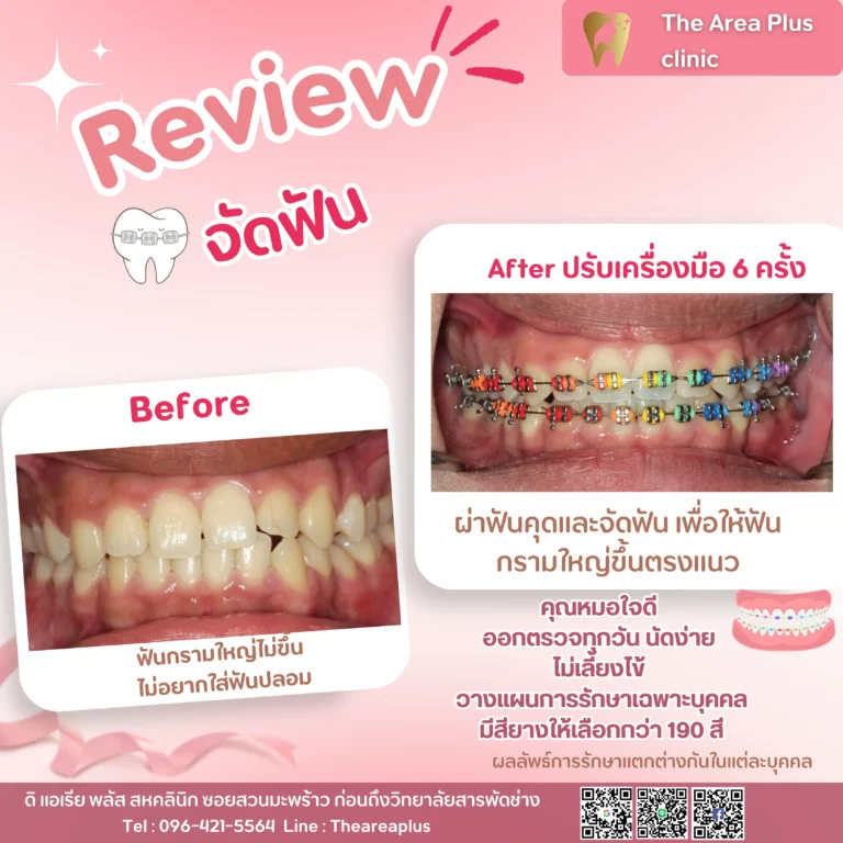 คลินิกทันตกรรมเฉพาะทางโคราช รีวิวจัดฟัน และ ผ่าฟันคุด