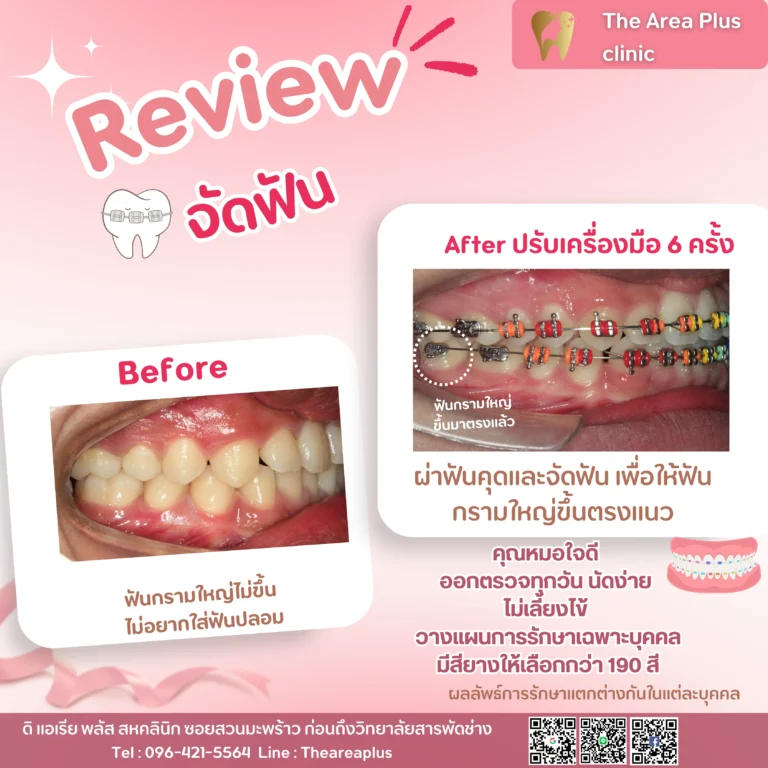 คลินิกทันตกรรมเฉพาะทางโคราช รีวิวจัดฟัน และ ผ่าฟันคุด