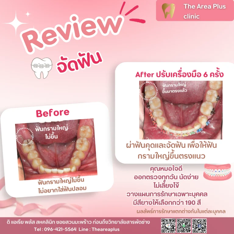 คลินิกทันตกรรมเฉพาะทางโคราช รีวิวจัดฟัน และ ผ่าฟันคุด