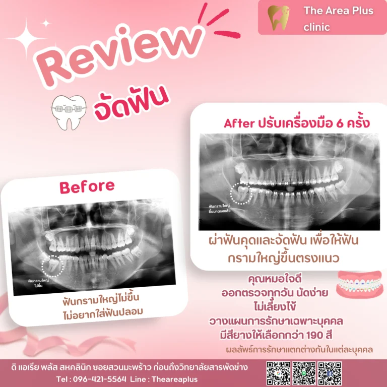 คลินิกทันตกรรมเฉพาะทางโคราช รีวิวจัดฟัน และ ผ่าฟันคุด
