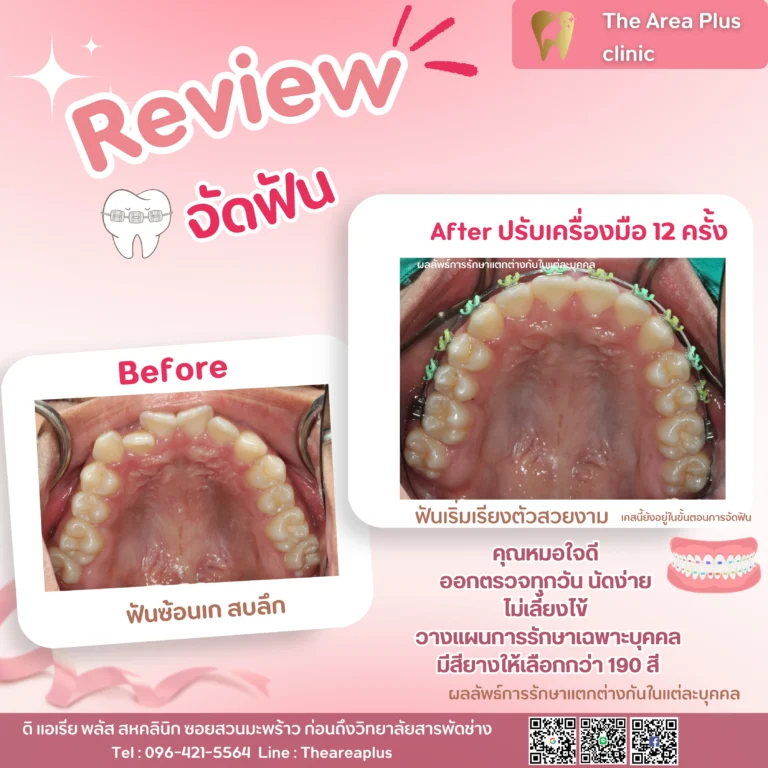 คลินิกทันตกรรมเฉพาะทางโคราช รีวิวจัดฟัน ฟันล่างสบคร่อมฟันบน (ไม่ผ่าตัด)