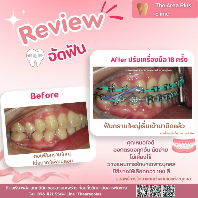 คลินิกทันตกรรมเฉพาะทางโคราช รีวิวจัดฟัน ฟันกรามใหญ่