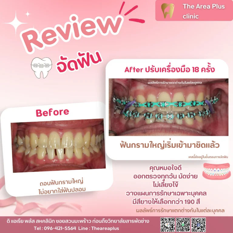 คลินิกทันตกรรมเฉพาะทางโคราช รีวิวจัดฟัน ฟันกรามใหญ่